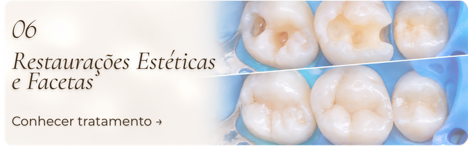 Restaurações Estéticas e Facetas